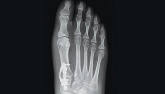 3d foot x-ray