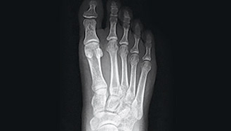 Normal foot x-ray