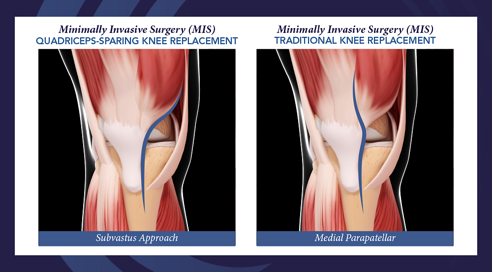 graphic comparing quadriceps-sparing knee replacement to traditional knee replacement